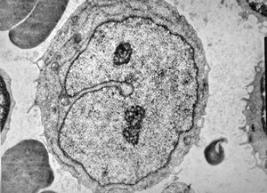 M,71y. | blood - blastic elements M,71y. | blood - blastic elements